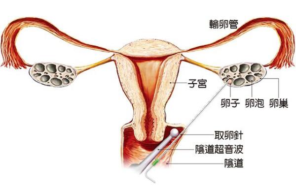 胚胎着床出血