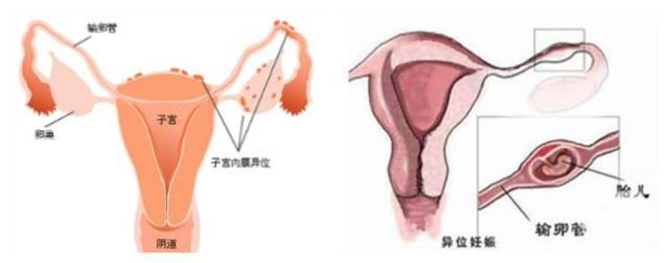 天津第三代试管婴儿